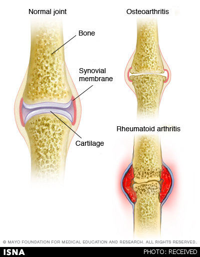 تفاوت آرتروز با آرتریت روماتوئید