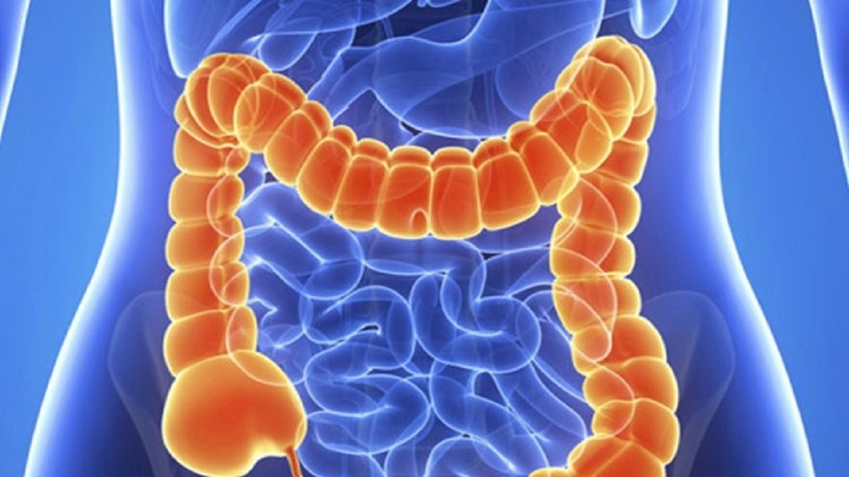 شاه علامت سرطان روده بزرگ را بشناسید/ دومین سرطان شایع مردان