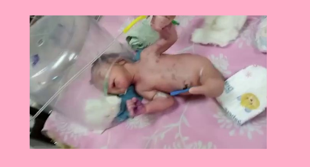 تولد یک نوزاد عجیب‌ الخلقه که به جای پا، دُم‌ دارد (+عکس)