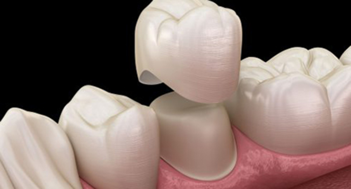 برای عفونت دندان روکش شده چه باید کرد؟