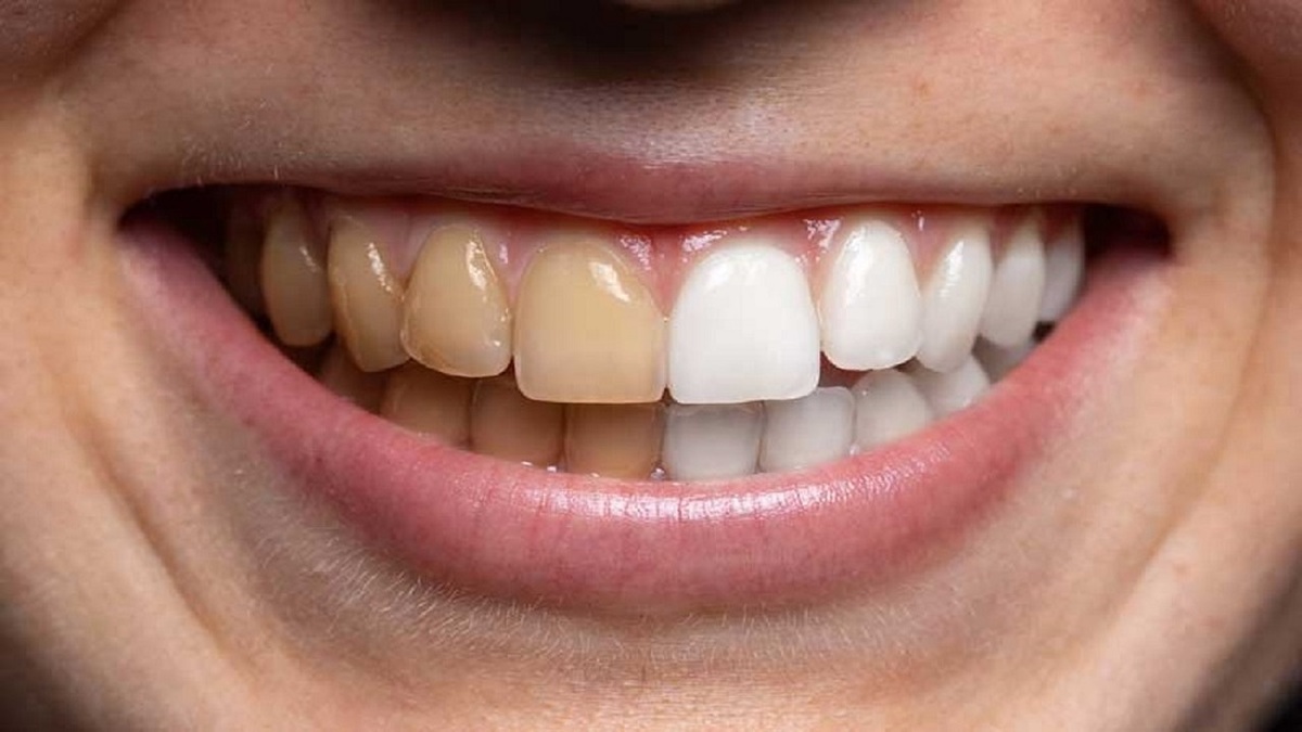 ببینید | مزاج شناسی به کمک جرم دندان